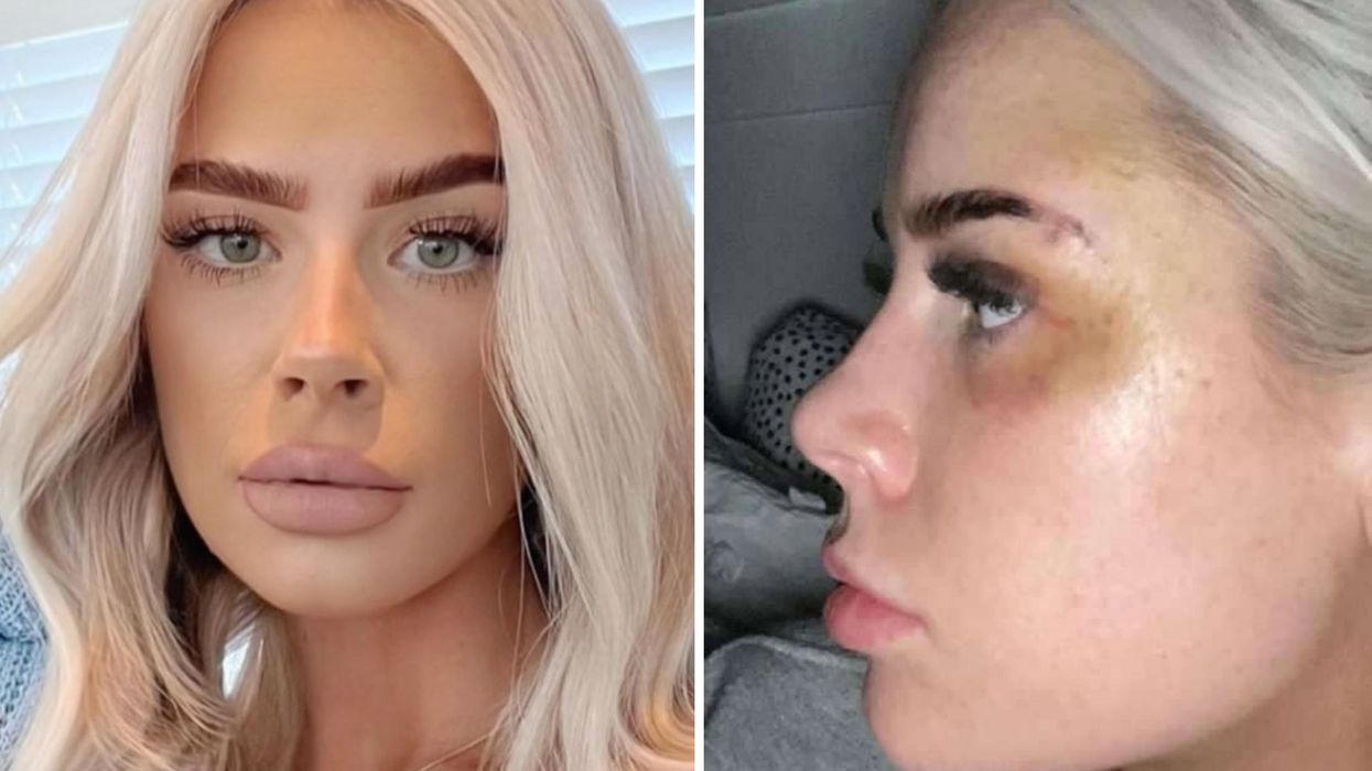 Woman left in tears as botched beauty treatment in a gym leaves her with a black eye