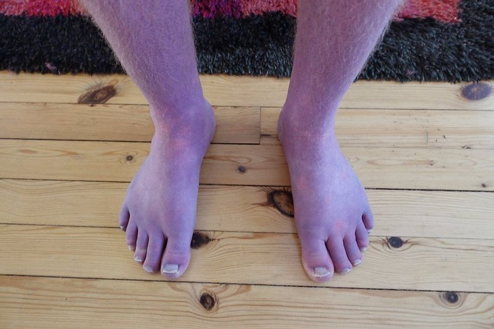 Man s legs turn purple in rare covid complication indy100