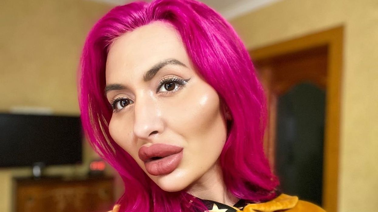 Model with 'world's biggest cheeks' raises concerns after latest doctor visit