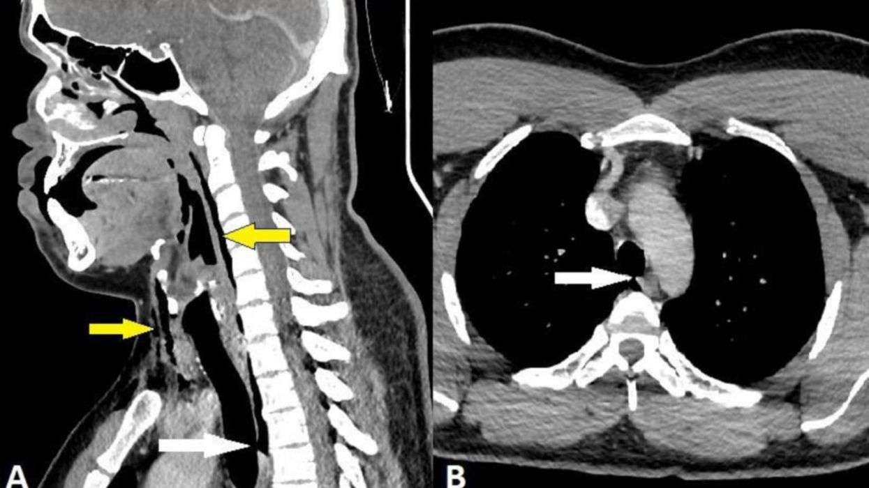 Man tears his windpipe after holding in a sneeze in a rare world first
