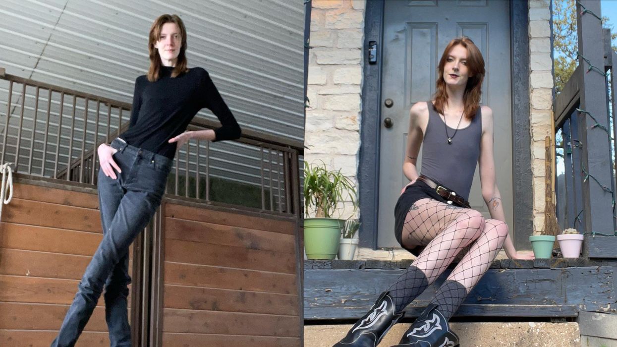 Woman with world's longest legs speaks out after being targetted by trolls