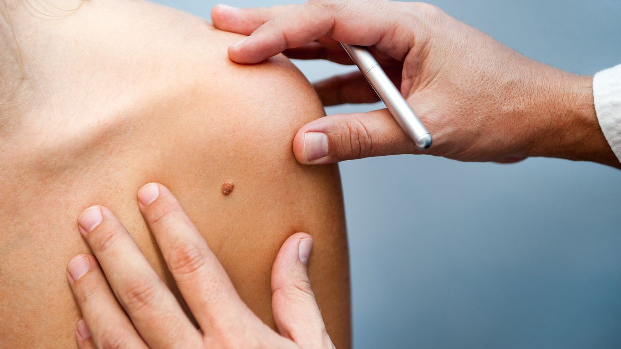 What is mole mapping and why is it important?