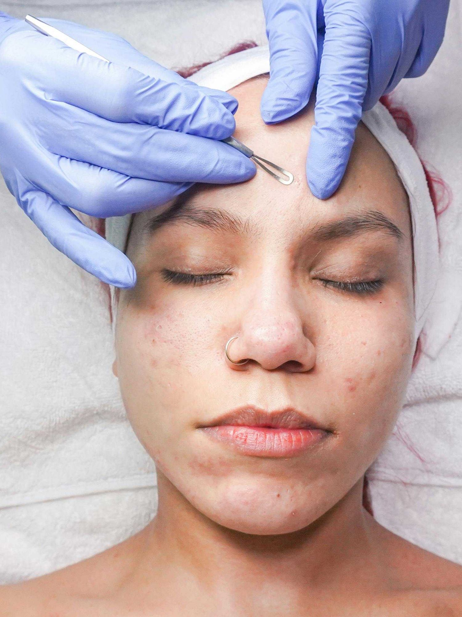 Why you should never pop a pimple in the 'triangle of death' on your face