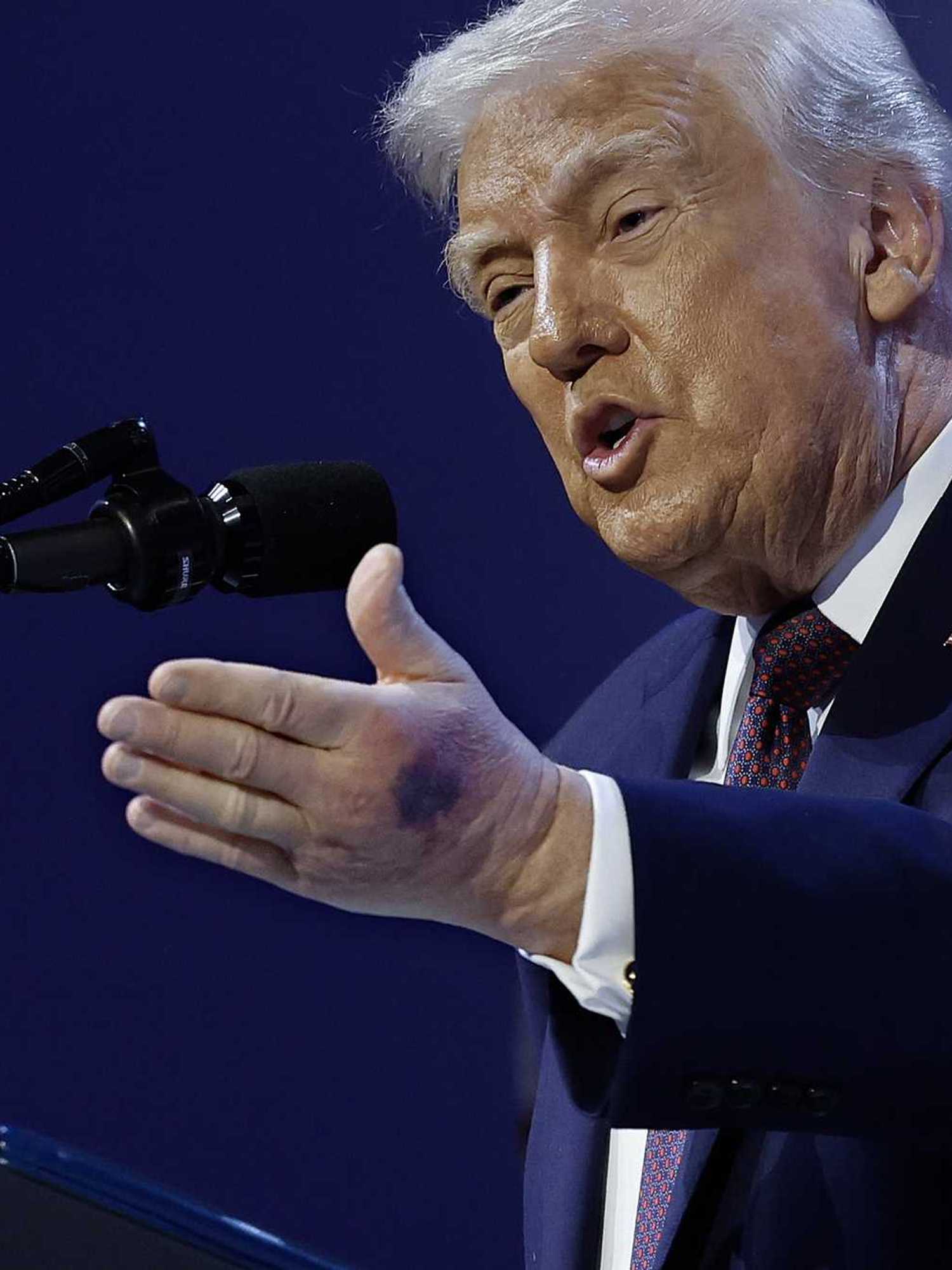 Donald Trump blames aspirin for visible bruising on his hands