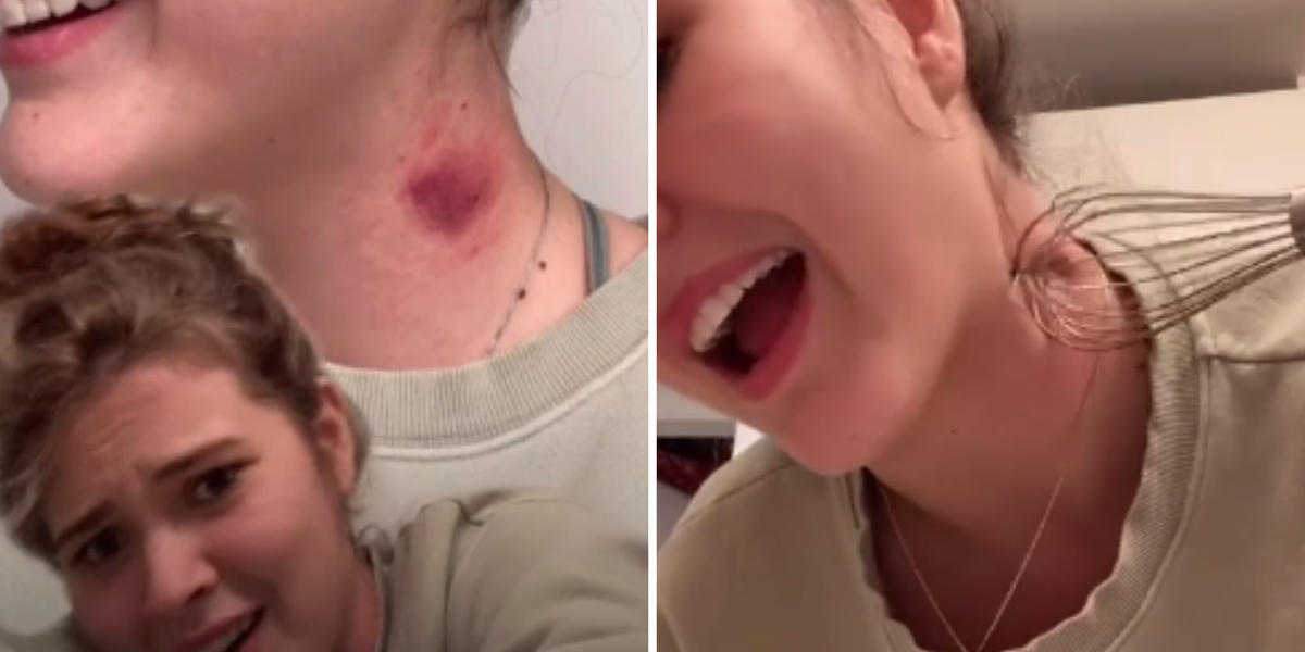 TikTok teens are using kitchen whisks to get rid of hickeys - but does it work? | indy100