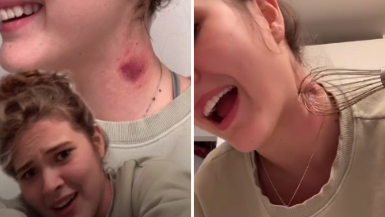 TikTok teens are using kitchen whisks to get rid of hickeys - but does it work?