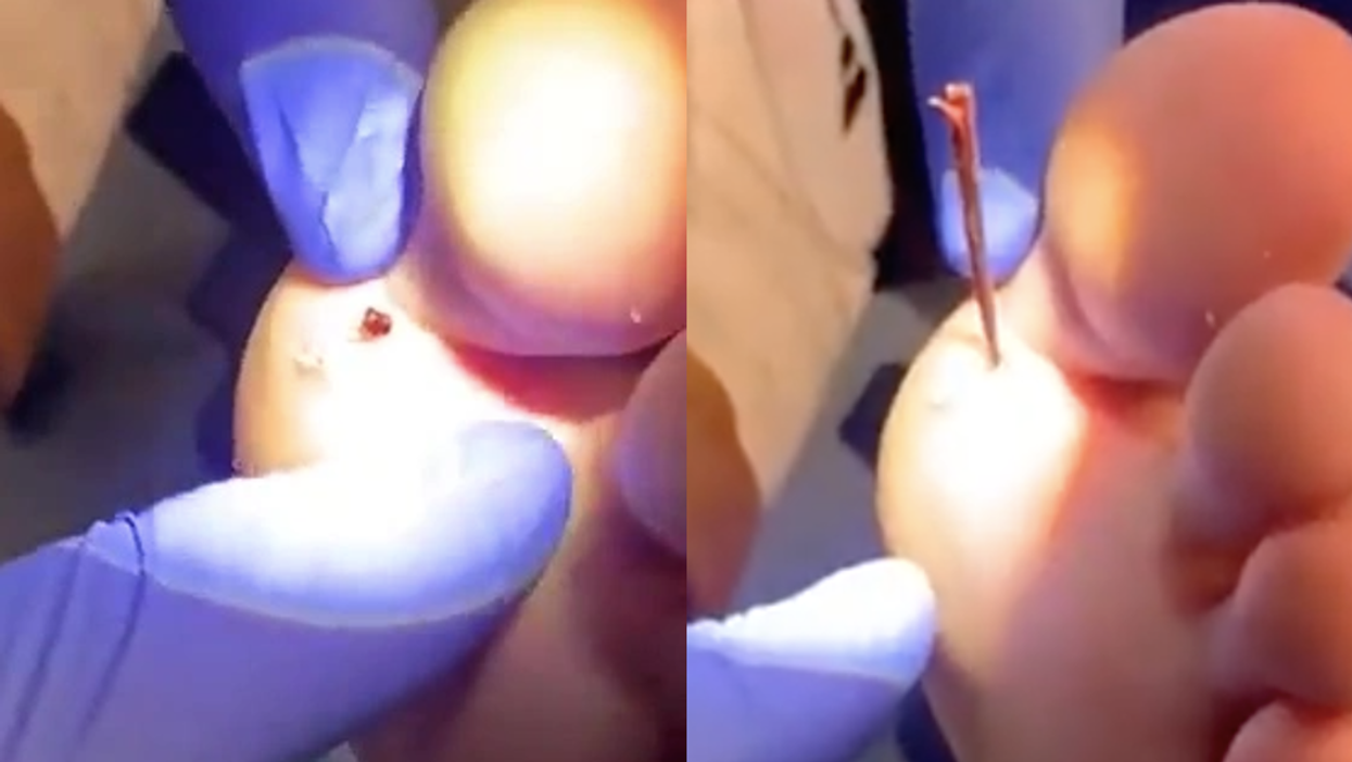 Gruesome video captures moment huge splinter of wood is removed from man’s foot