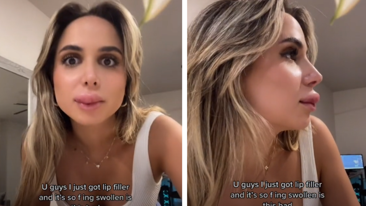 Woman compared to ‘the Grinch’ after showing lip filler results on TikTok
