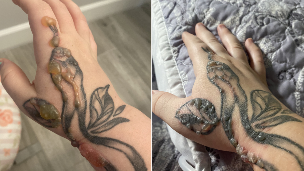 Mum was horrified when warts started growing on her forearm tattoo - that had to be burned off