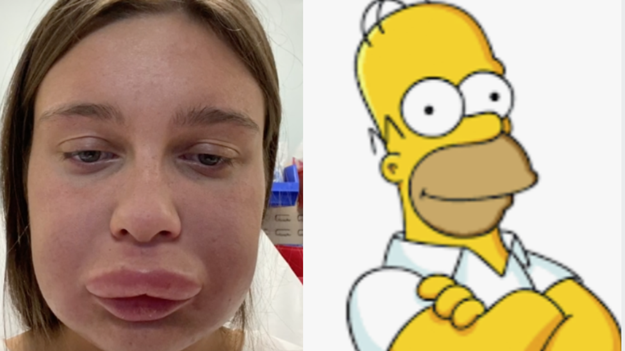 Woman told she looks like Homer Simpson after disastrous lip fillers