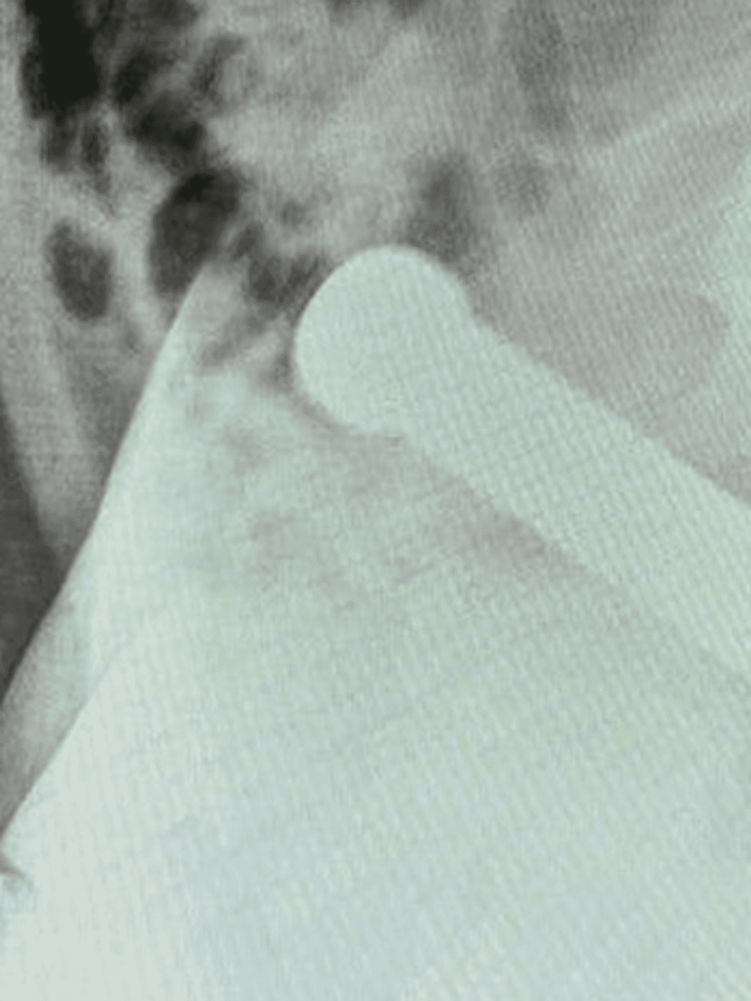 Man gets 2kg dumbbell stuck in his bum