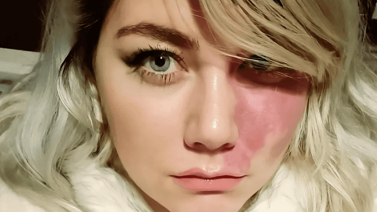 Woman inundated with emails from men after her birthmark photo went viral