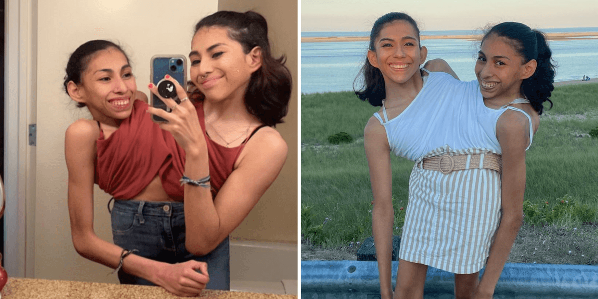 Conjoined sisters share a body but only one has a boyfriend and the ...