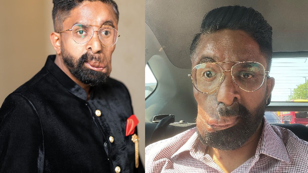Man who wears prosthetic eye due to rare condition hopes his story can inspire others