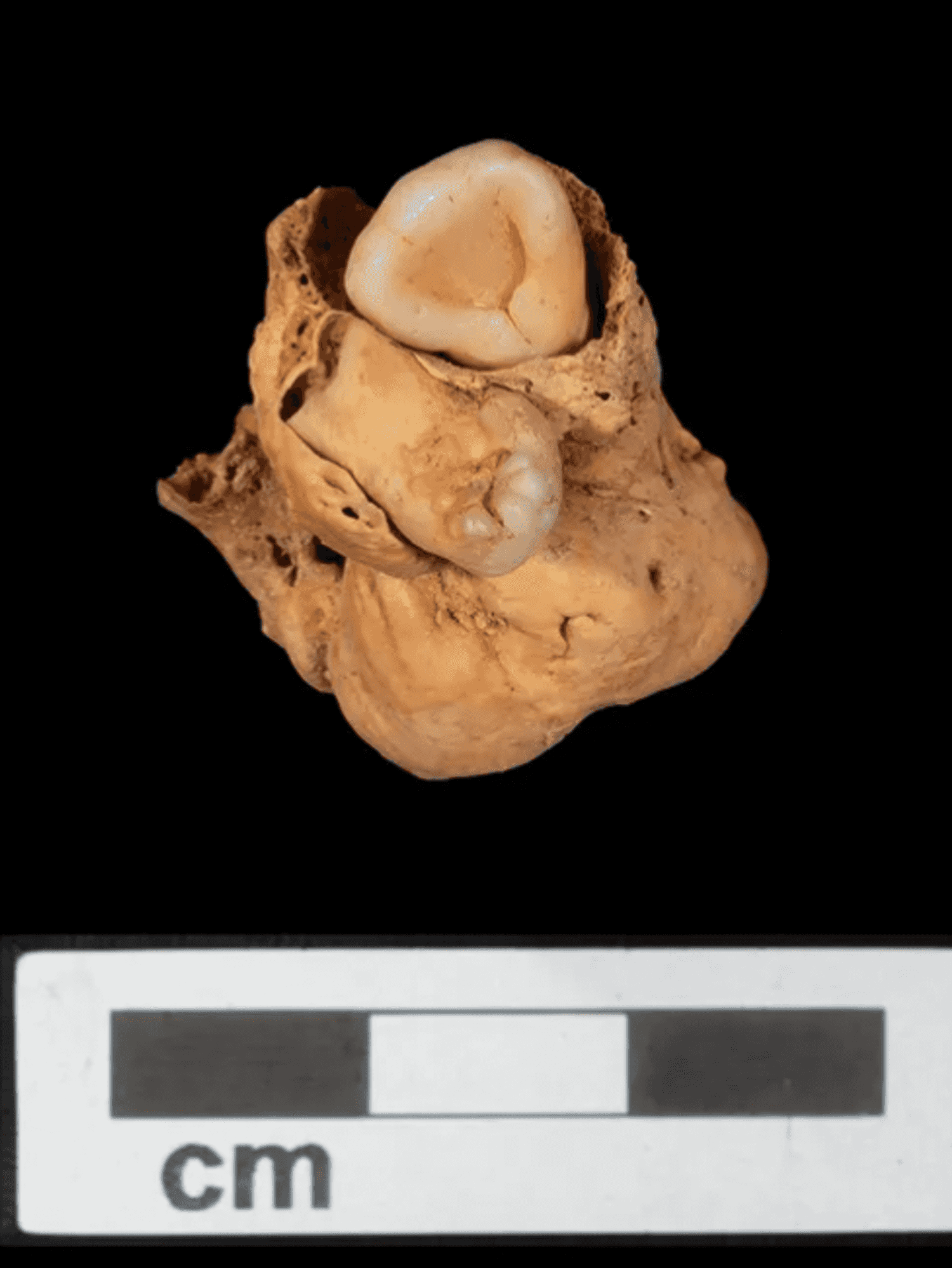 Creepy 3000-year-old tumour 'with teeth' found in ancient burial site