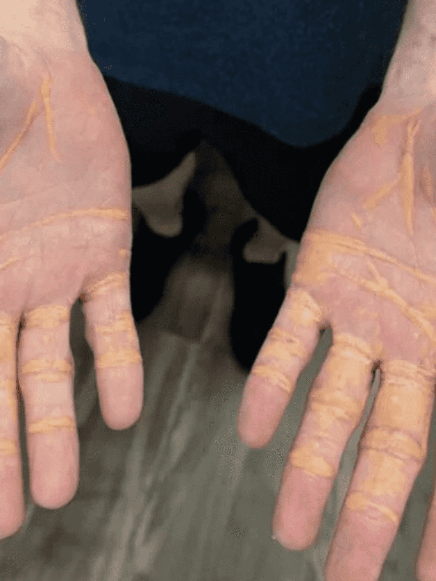 Man hospitalised after carnivore diet made cholesterol ooze from his hands and feet