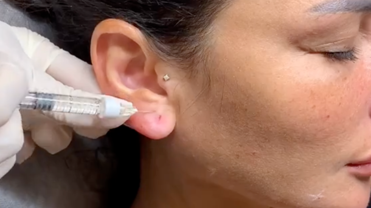 People are getting filler in their ears and the internet says beauty has gone too far