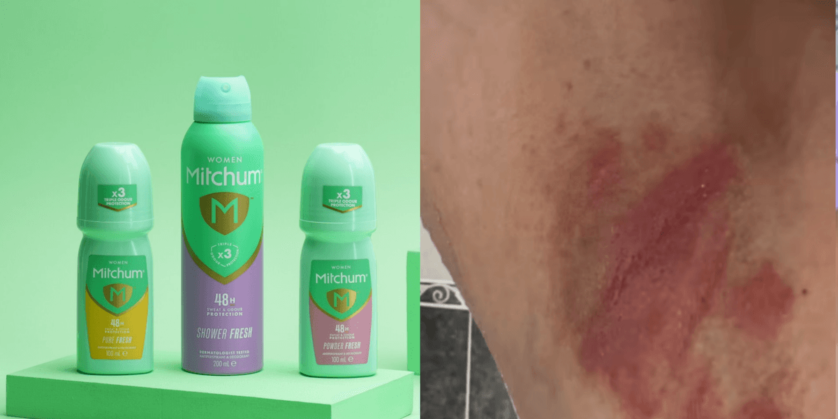 How To Document Skin Rash What has Mitchum said about deodorant scandal? Hundreds document ‘burnt ...