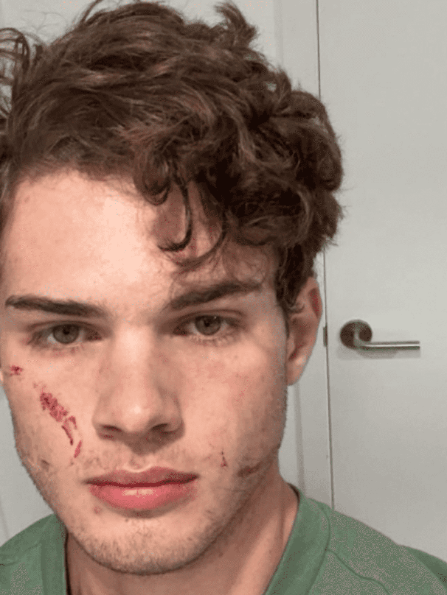 'Looksmaxxing' influencer Clavicular breaks silence after recent hospitalisation