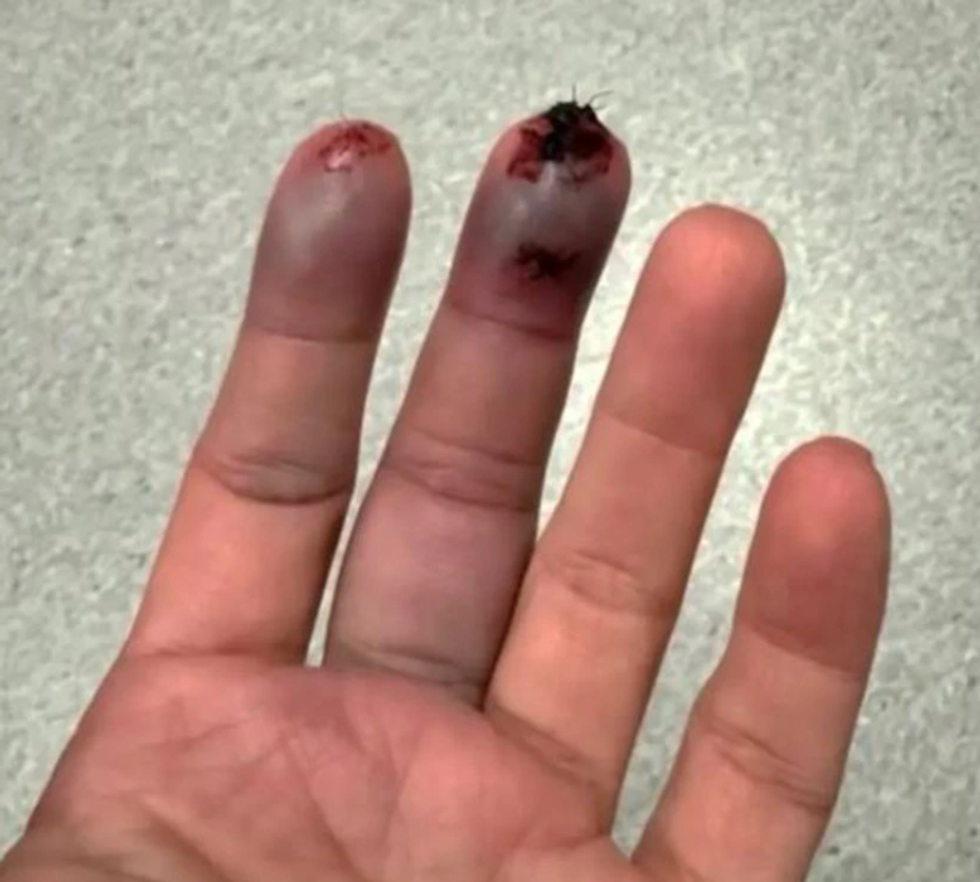 Kim Kardashian's gruesome finger injury on the latest episode of The Kardashians