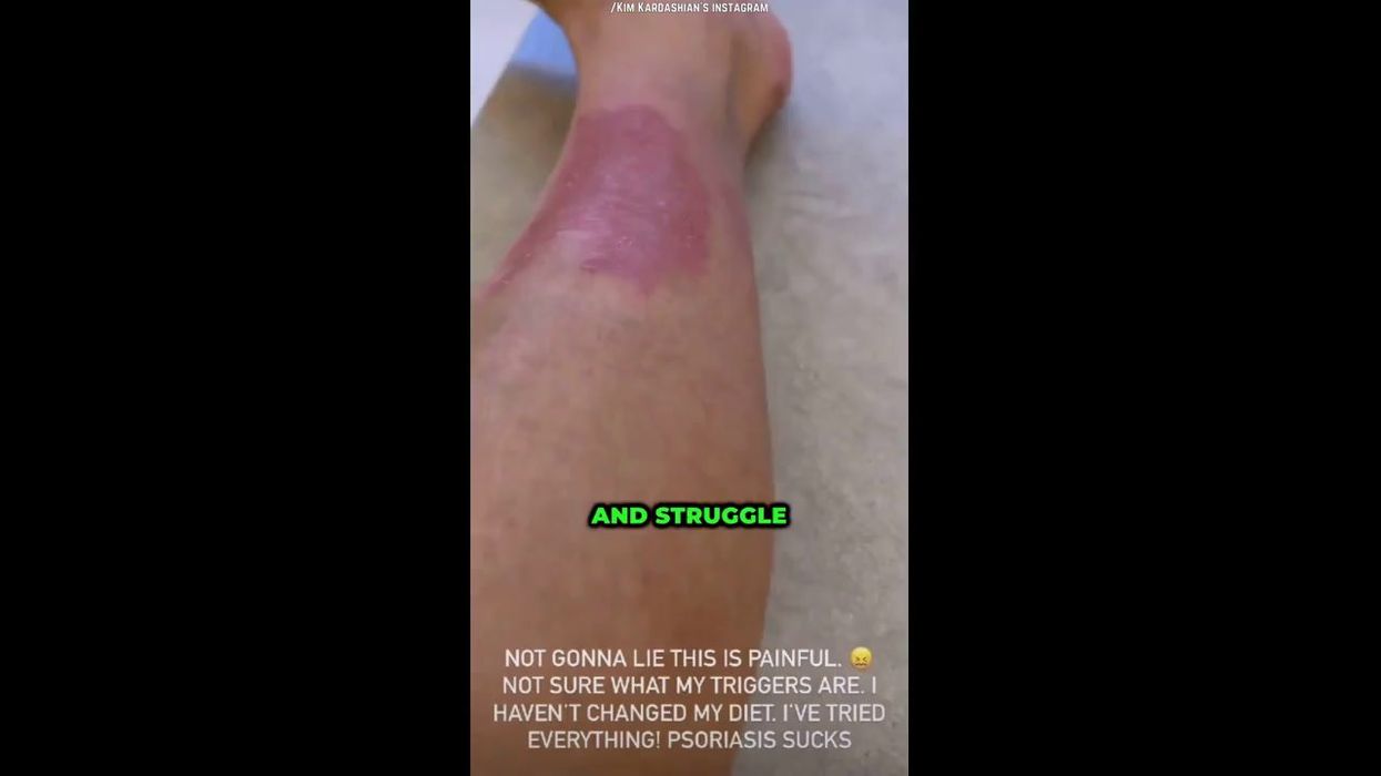 Kim Kardashian praised for sharing vulnerable video about psoriasis