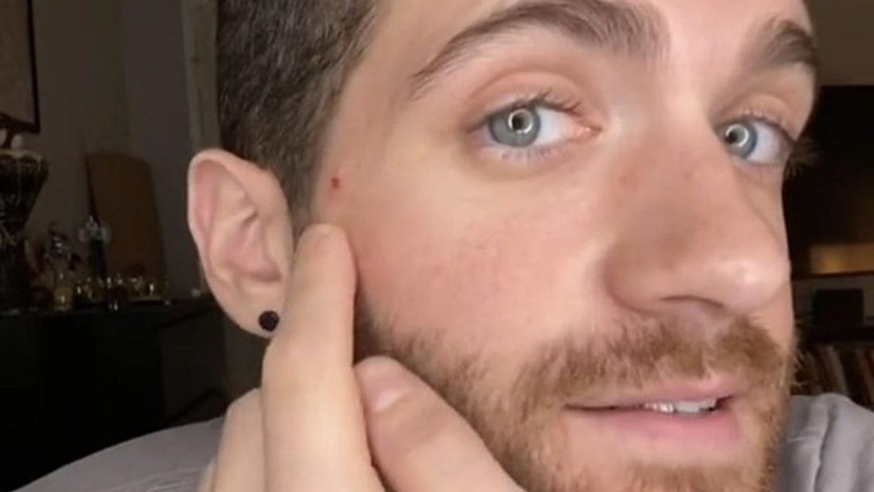 Man opens up about what it's really like to have monkeypox