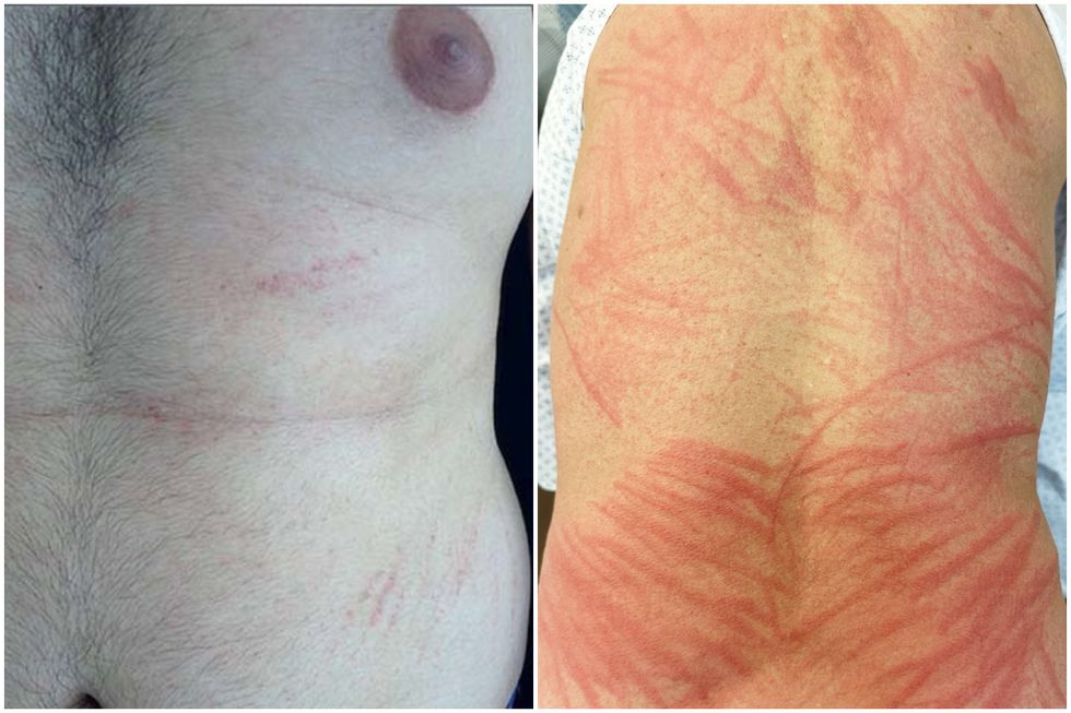 Cases are increasing of 'shiitake dermatitis' a reaction to