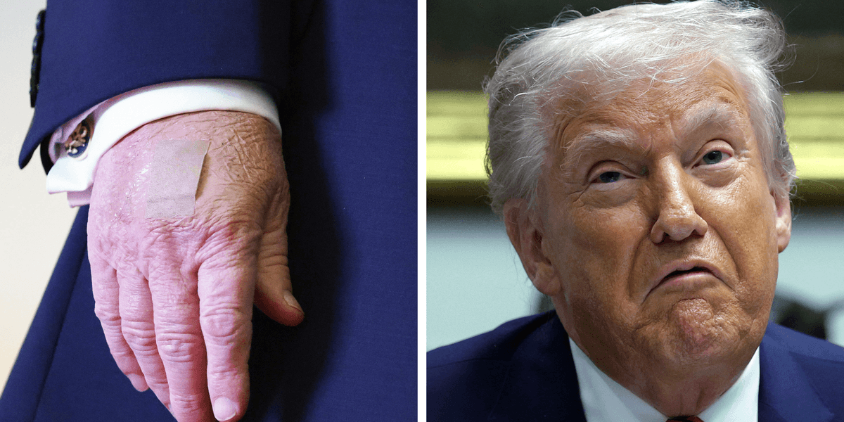 White House issues fresh explanation for Trump’s covered hand | indy100