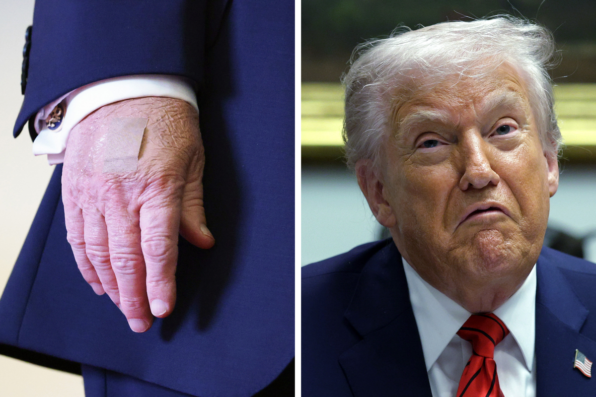 Left, Donald Trump's right hand with a bandage on the back of it. Right, Donald Trump frowning mid-speech.