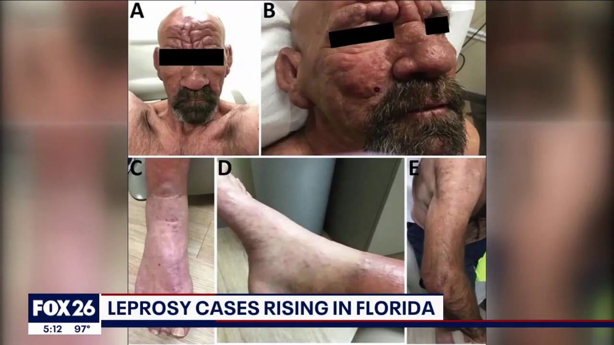 Leprosy is making a comeback in Florida