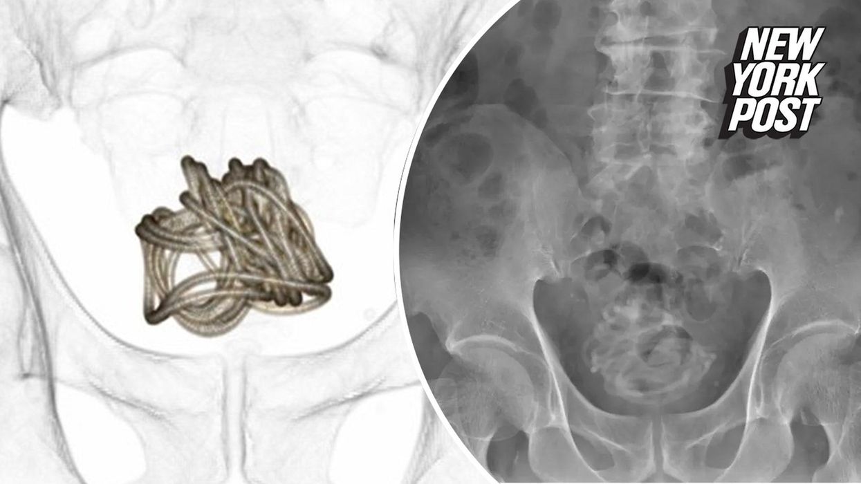 90-inch rope stuck inside man's bladder after he shoved it inside his penis