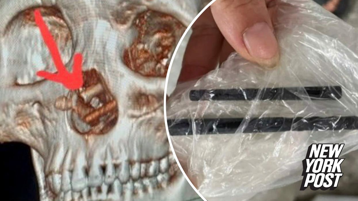 Doctors find chopsticks lodged in the brain of a man with persistent headaches