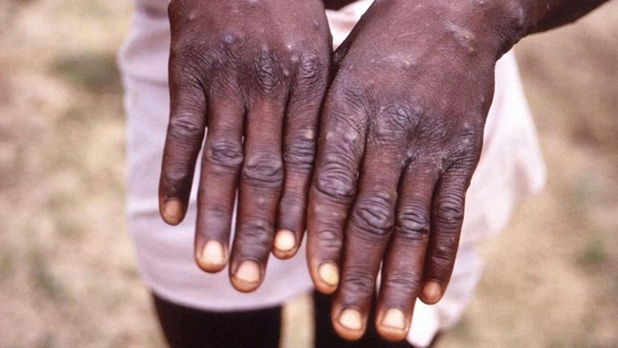 Man's nose begins to rot after monkeypox was dismissed as just sunburn