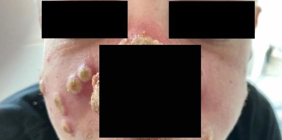 Monkeypox patient's nose is rotting after being dismissed as sunburn