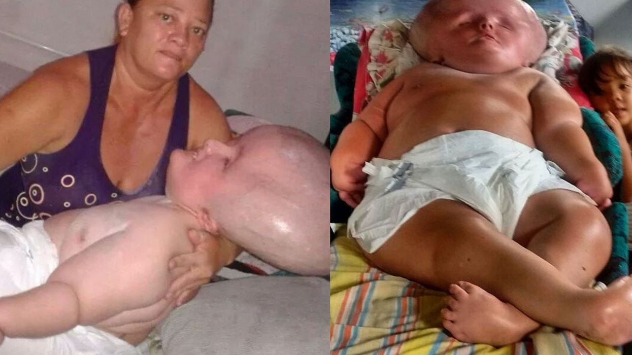 'My daughter's head wouldn't stop growing – people call her names but I think she's beautiful'
