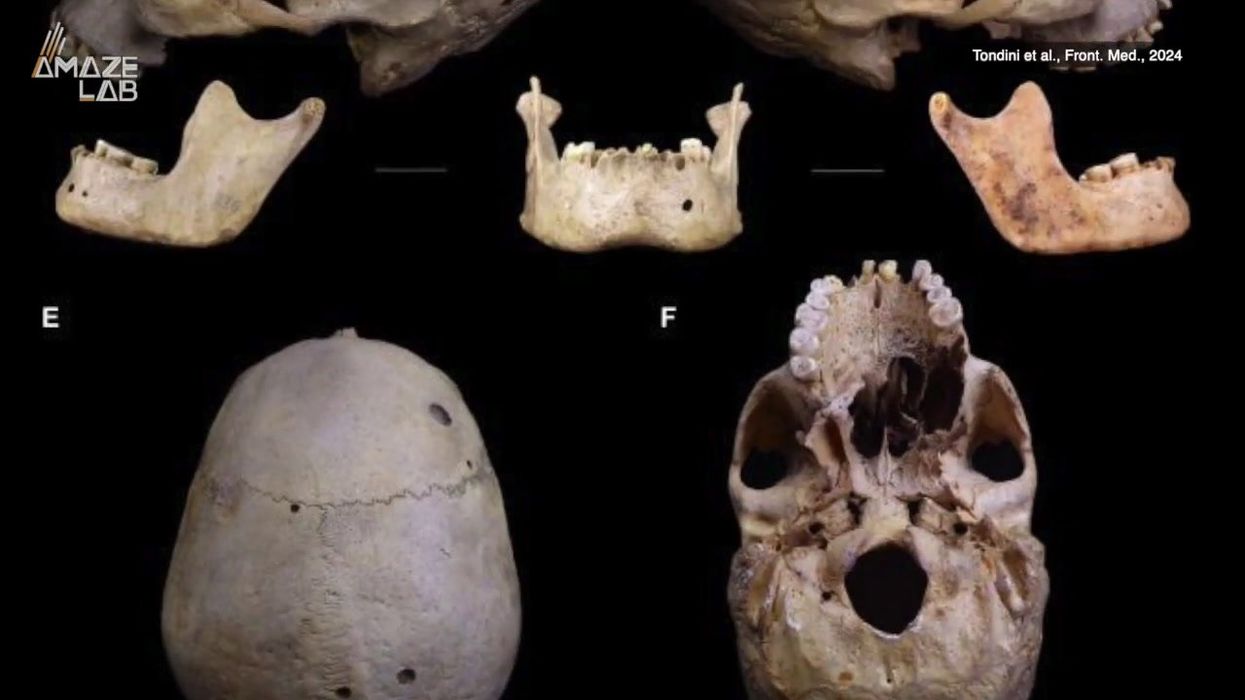 4,000-year-old skull gives ‘extraordinary’ clues about cancer treatment