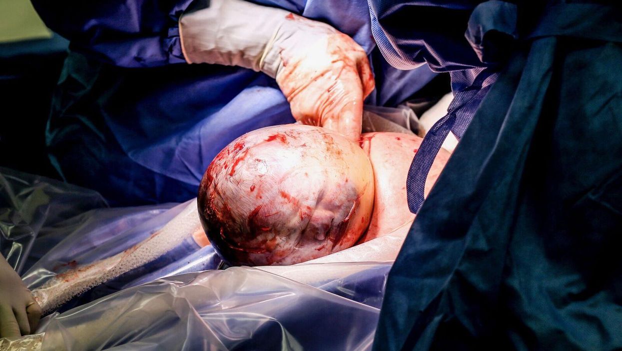 Rachael and Nate Burow were stunned when little Annabelle was born with a caul