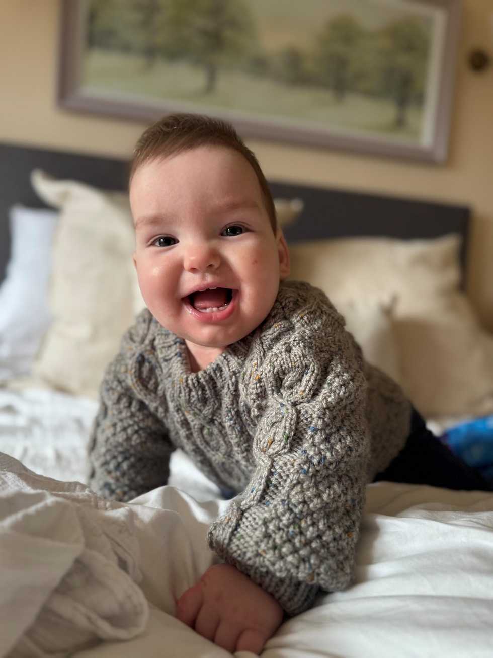 ‘Happy and cheeky’ Rory given world-first treatment for rare skull condition