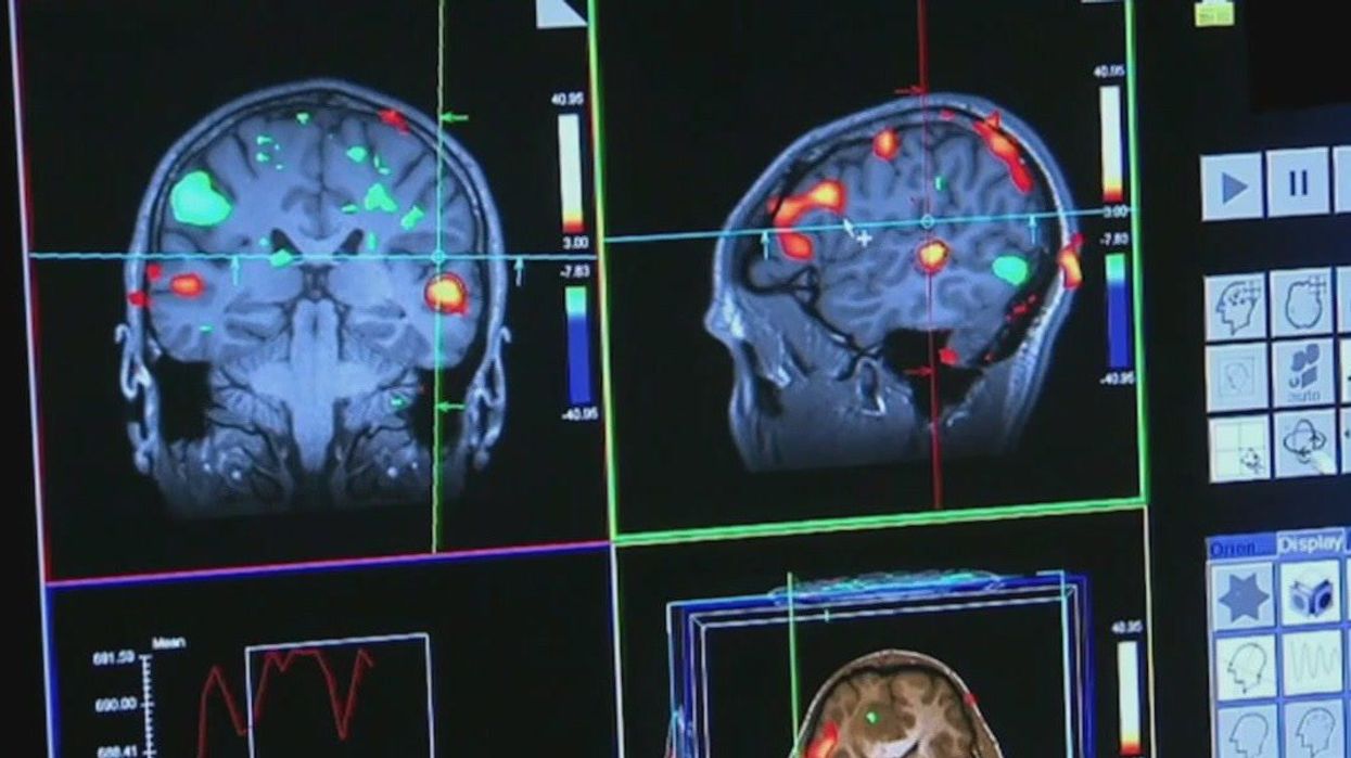 Inhaling xenon gas could be potential effective Alzheimer's treatment, researchers believe