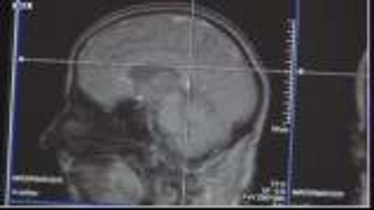 Study unveils fascinating case of man shot in the head who saw the world backwards