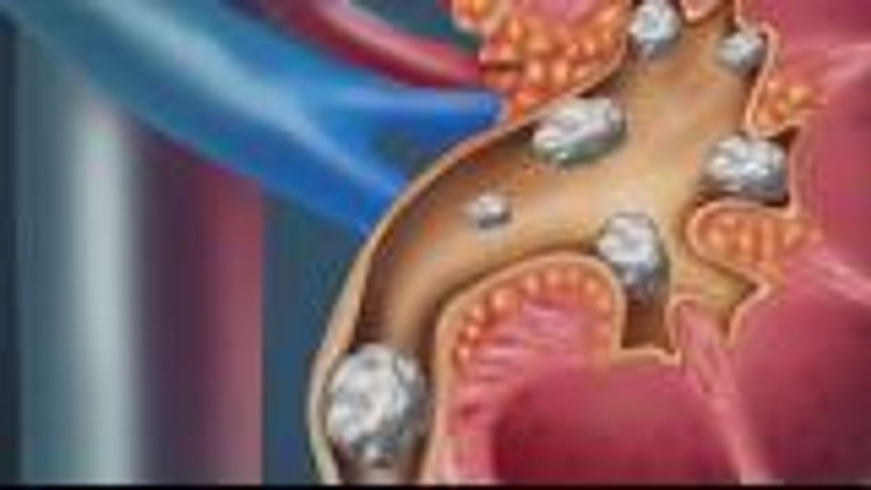 Here's why kidney stones can be treated by going on a rollercoaster