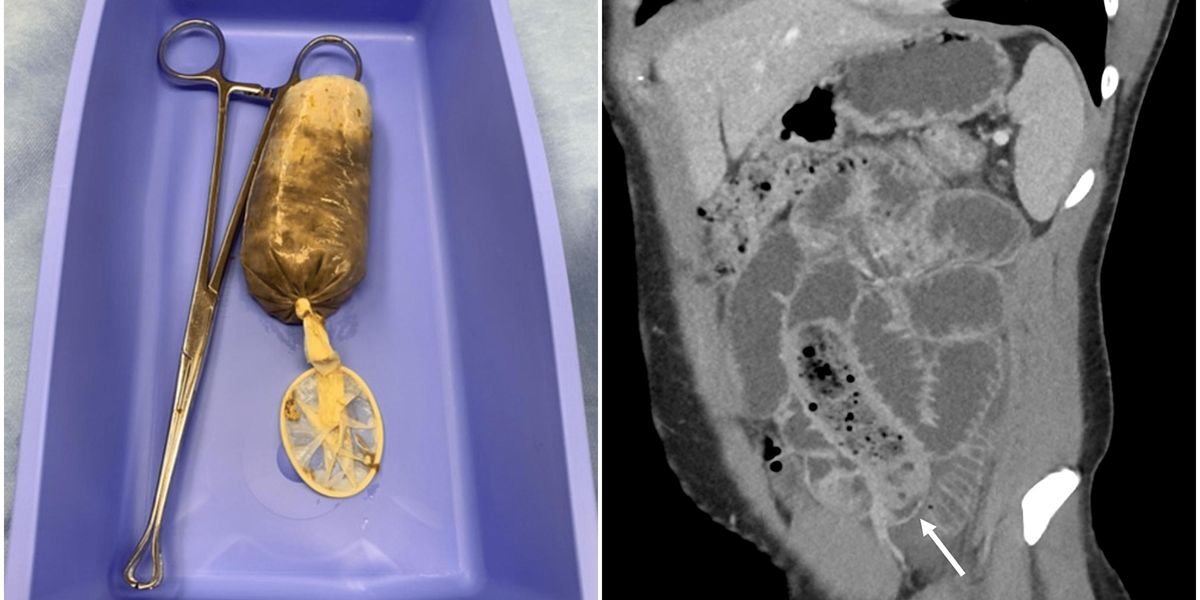 Man hospitalised for eating condom wrapped banana condom in 'hormonal ...