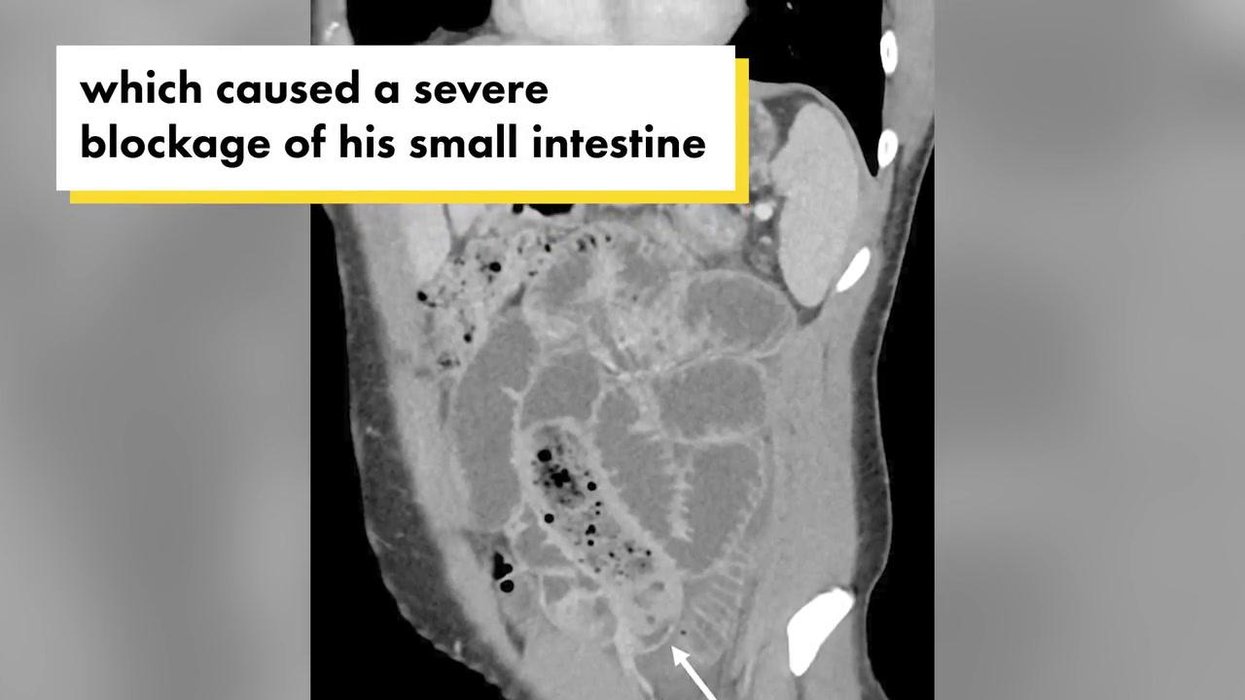 Man hospitalised for eating condom wrapped banana condom in 'hormonal ...