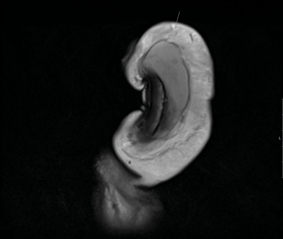 The 40-year-old suffered from a 3cm vertical tear