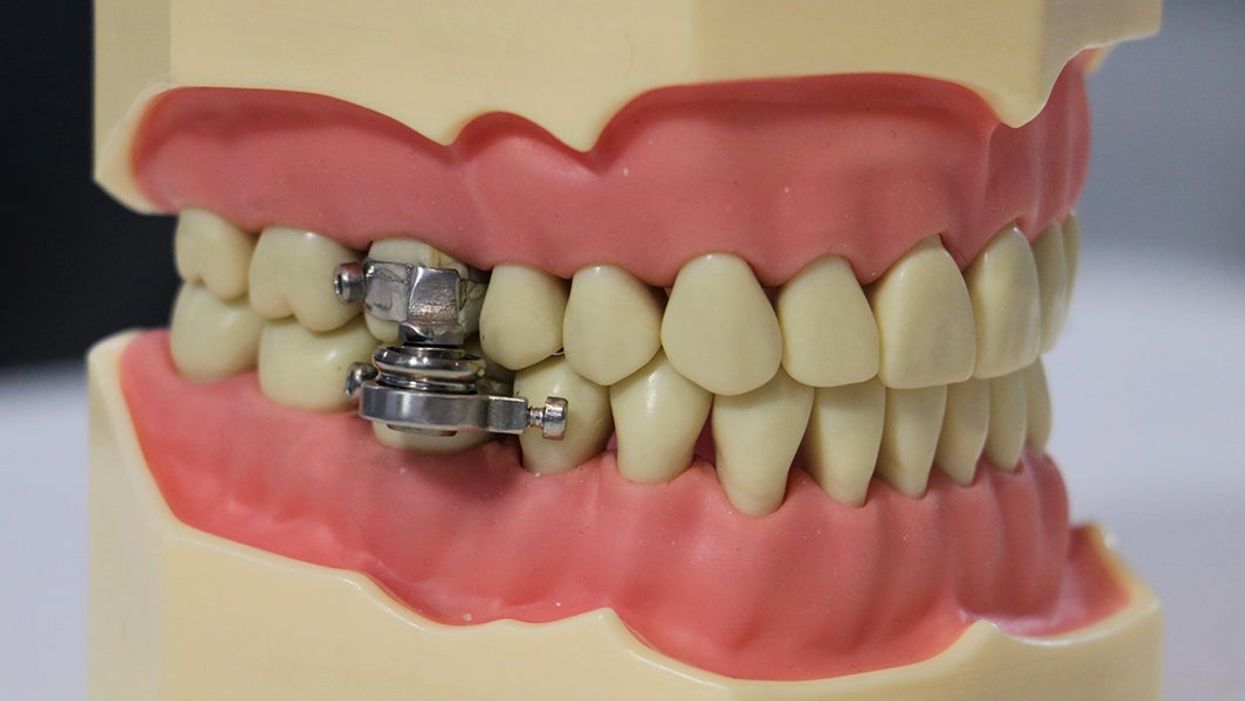 <p>The ‘DentalSlim Diet Control’ device.</p>