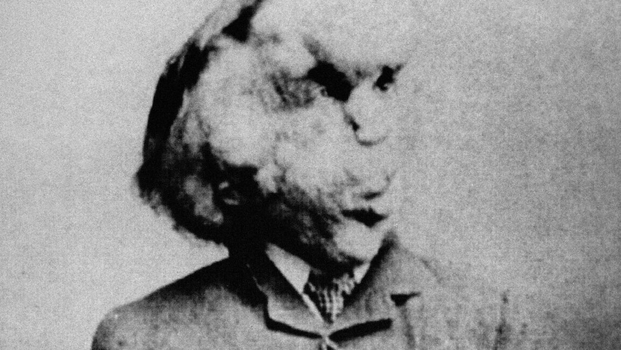 <p>The Elephant Man, Joseph Merrick, whose appearance was probably a result of Neurofibromatosis</p>