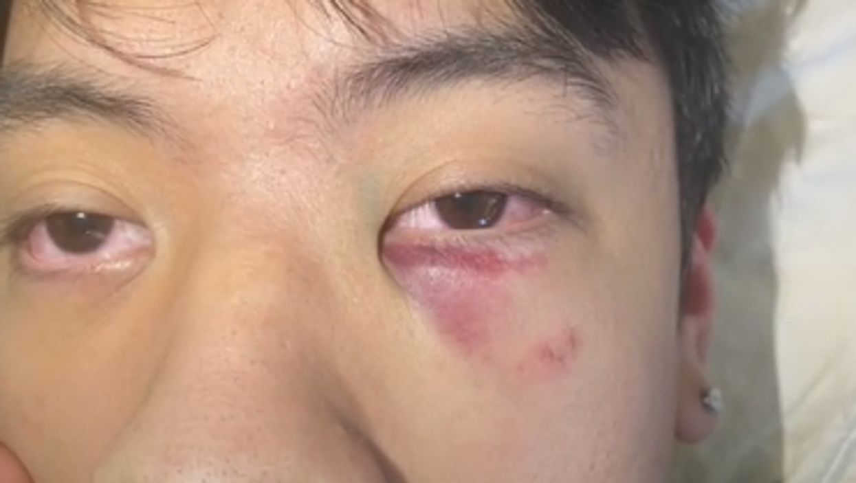 The teen suffered from bruising and swelling as a result of the alleged attack.