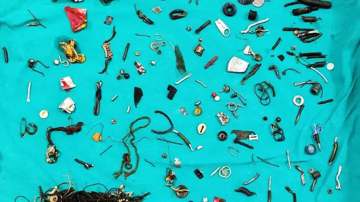 Doctors find 60 household items in man's stomach after complaining about cramps