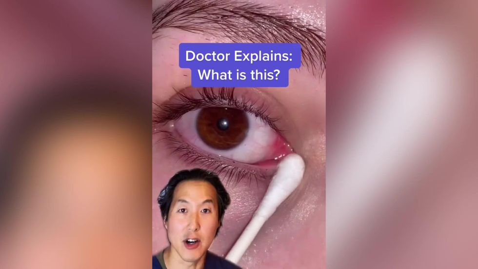 Experts warn against 'fishing' out eye mucus trend as seen on TikTok |  indy100