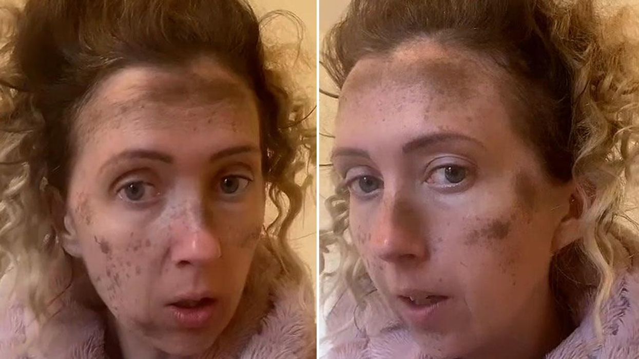 TikTok fake freckle trend leaves woman looking like a chimney sweeper